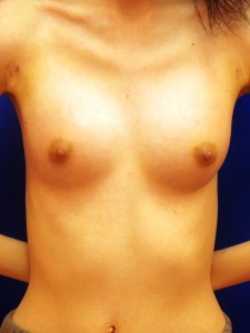 ①術後1ヶ月 正面